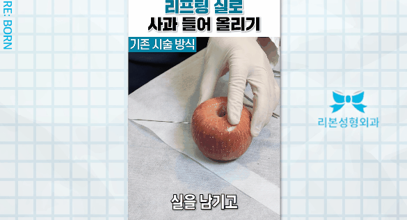 마리오네트 리프팅 가격, 비용 관련해서 궁금하다면 관련 이미지 2