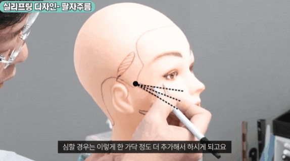 Apgujeong thread lifting review: Can you decide just by looking at before-and-after photos? image 1