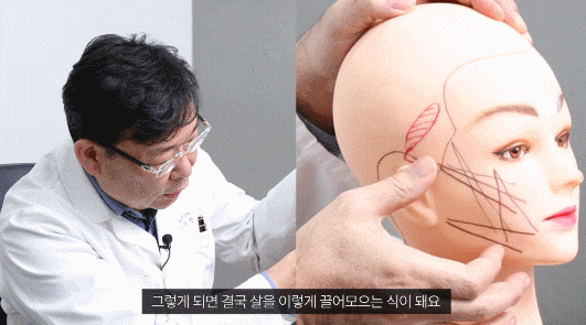 If You Decide Based Only on Before-and-After Photos for Gangnam Mini Facelift, You’ll End Up Regretting It image 5