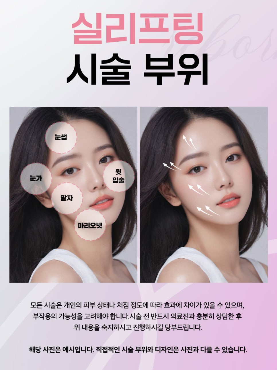 녹는실 리프팅 유지 기간 탄력까지 오래 지속시키기 위해서는? 관련 이미지 3