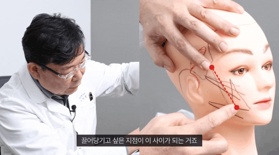 심부볼 처짐 원인과 증상에 따른 시술 효과는? 실리프팅 통증 유지기간 등 관련 이미지 5