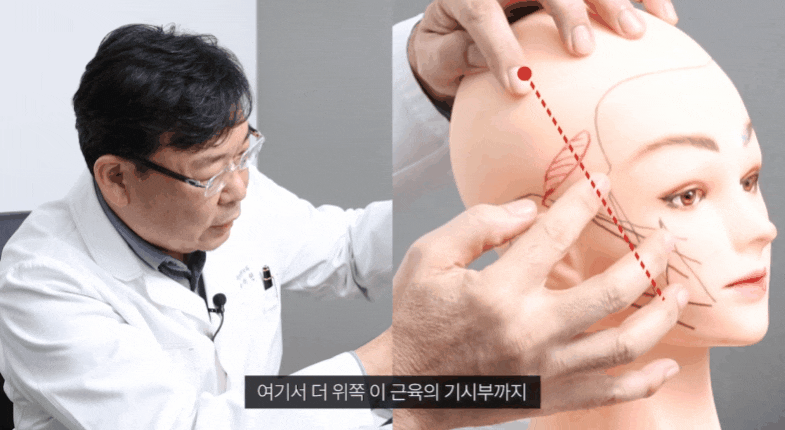 What Causes Sagging Skin and Wrinkles, and How Effective Is Thread Lifting? image 5