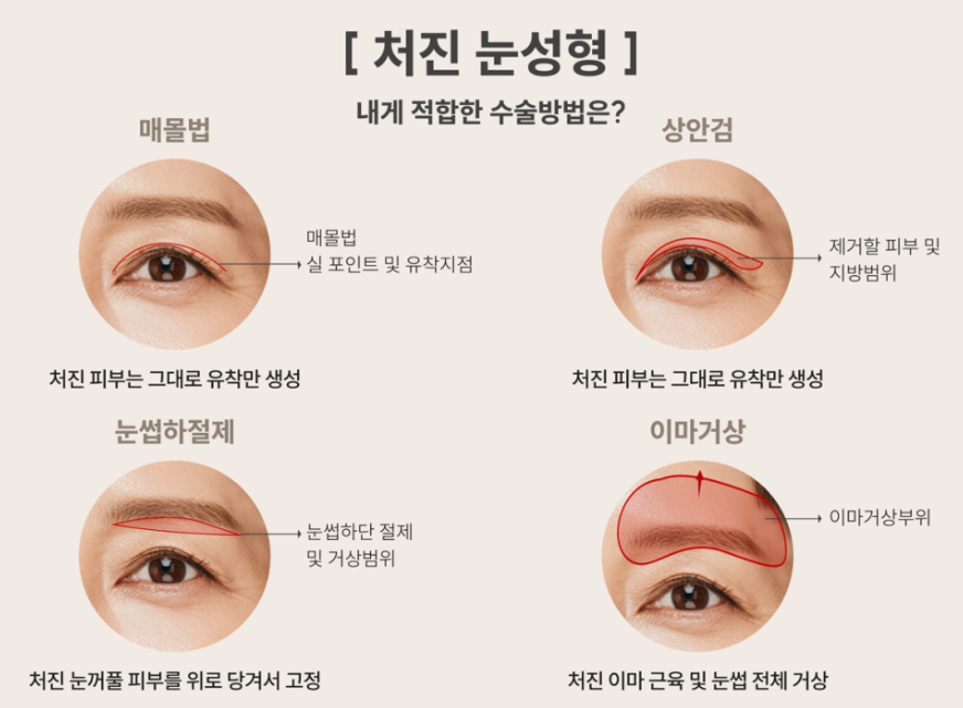 중년눈처짐 수술 받을 때 성형외과 상담 중요합니다. 관련 이미지 1