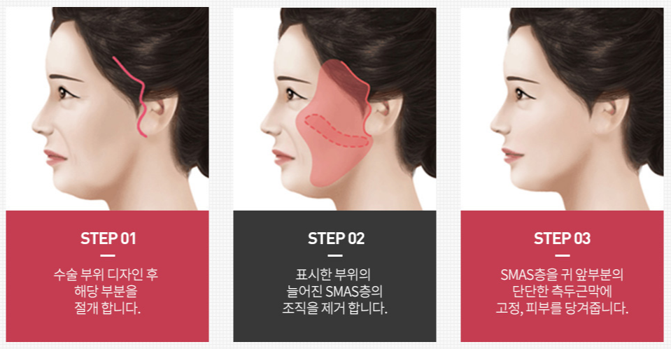 신사동 안면거상술 유명한곳? 피부만 당기면 실패할 확률 높습니다. 관련 이미지 2