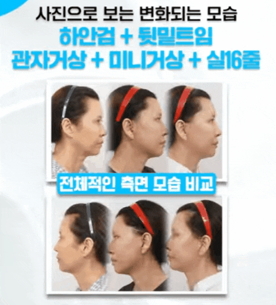 What Should You Check Before Getting Thread Lifting Near Apgujeong Station? image 1