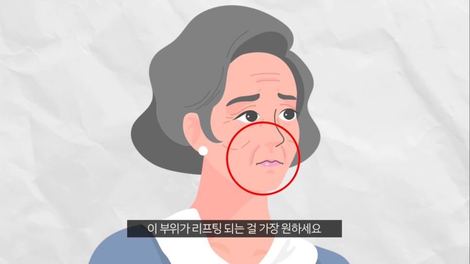 압구정 리프팅 성형외과 미니거상 찐 후기를 원한다면 관련 이미지 6