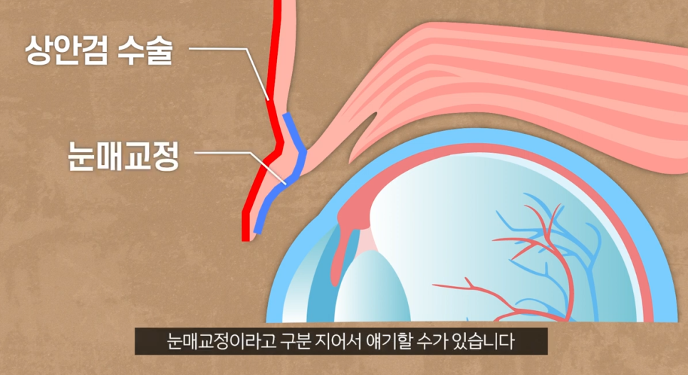 압구정 눈매교정가격 20대~70대 까지 관련 이미지 2