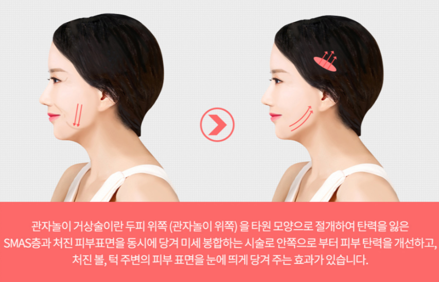 A Plastic Surgery Specialist Explains Facelift Lifting Prices image 3