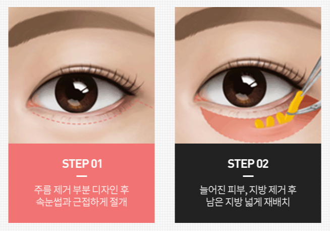 Midlife Eye Surgery Price, Is Cost Really Important? image 3