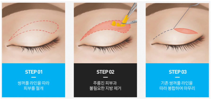 Famous Plastic Surgery Clinic in Nonhyeon-dong? A Specialist Answers Questions About Ptosis Correction (Q&A) image 4
