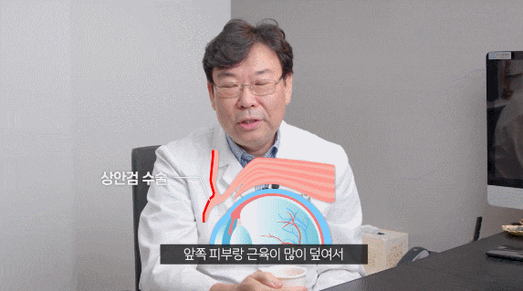 신논현 상안검수술 받을 때 유의사항 말씀드립니다. 관련 이미지 2