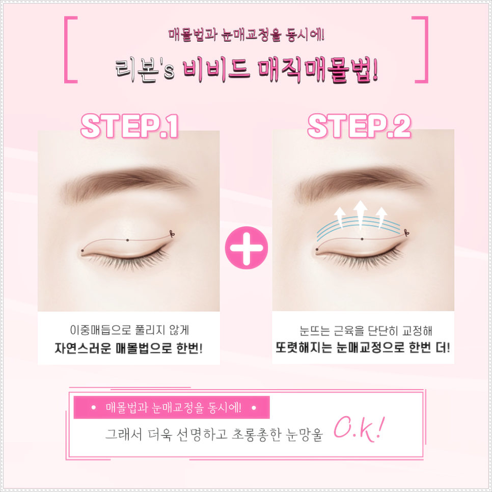 강남의 쌍꺼풀 매몰 후기 좋은 리본의 매직매몰★ 관련 이미지 3
