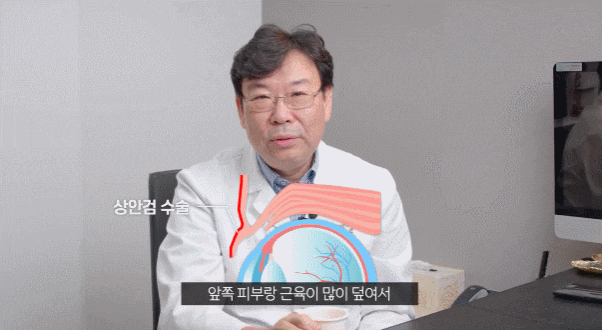 신사동성형외과 상안검수술 효과 없는 분들 특징 관련 이미지 5