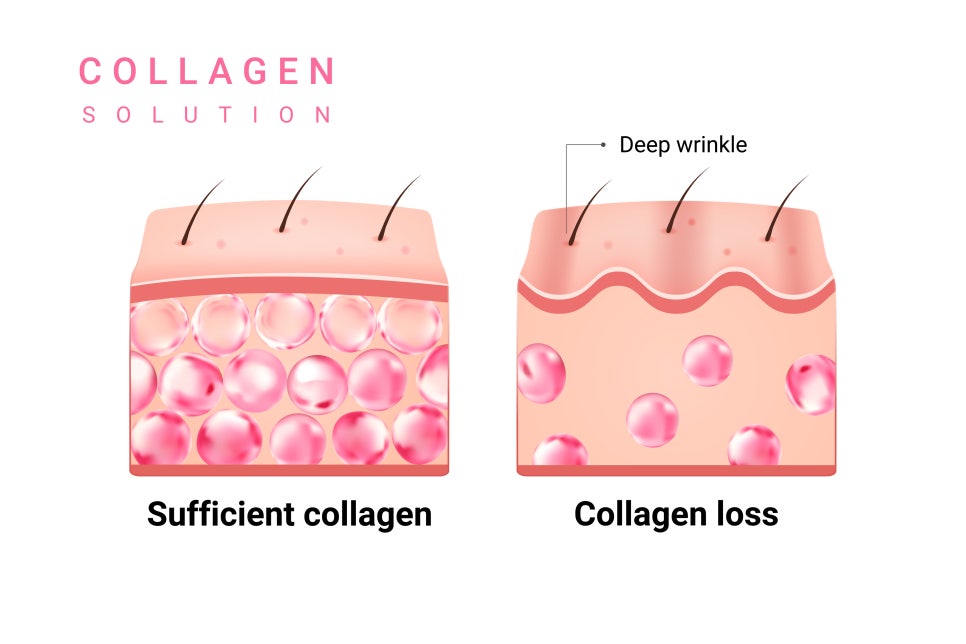 What Are the Effects of Collagen Injections in Apgujeong for Improving the Skin’s Natural Elasticity? image 4