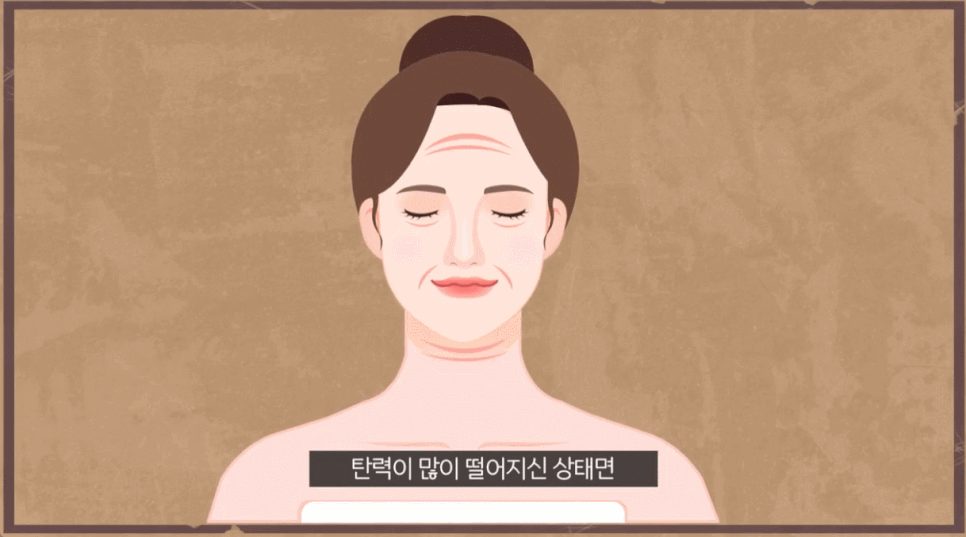 심부볼 처짐 실리프팅으로 개선하기 위해서 꼭 알아봐야 할 것 관련 이미지 2