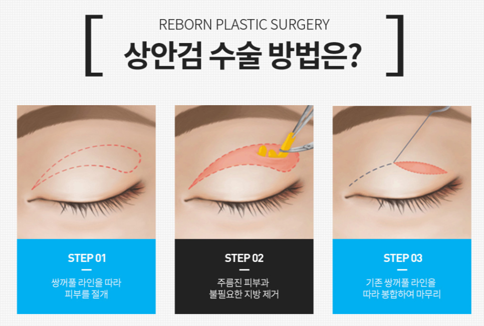A Good Plastic Surgery Clinic Near Sinsa Station for Upper Blepharoplasty image 3