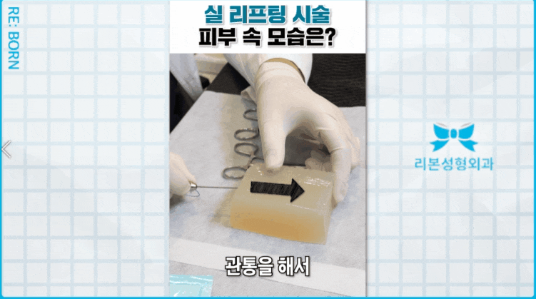 Please read this if you are looking for the best place for thread lifting in Apgujeong image 3