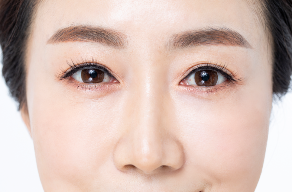 Why Do We Recommend Thread Lifting More Than Midface Lift Surgery? image 5