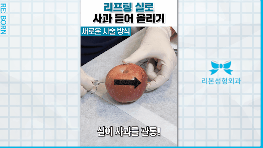 Swelling, Recovery Period, Precautions, and More After Thread Lifting image 2