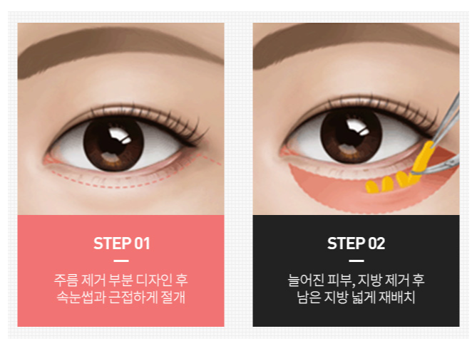 Organizing Midlife Eye Surgery in Sinsa-dong. image 4