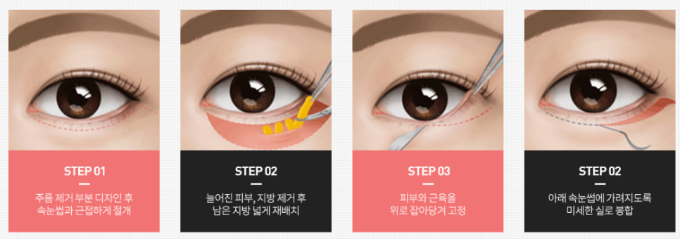 하안검수술 비용, 가격 눈밑 주름 늘어짐 개선 효과는? 관련 이미지 3