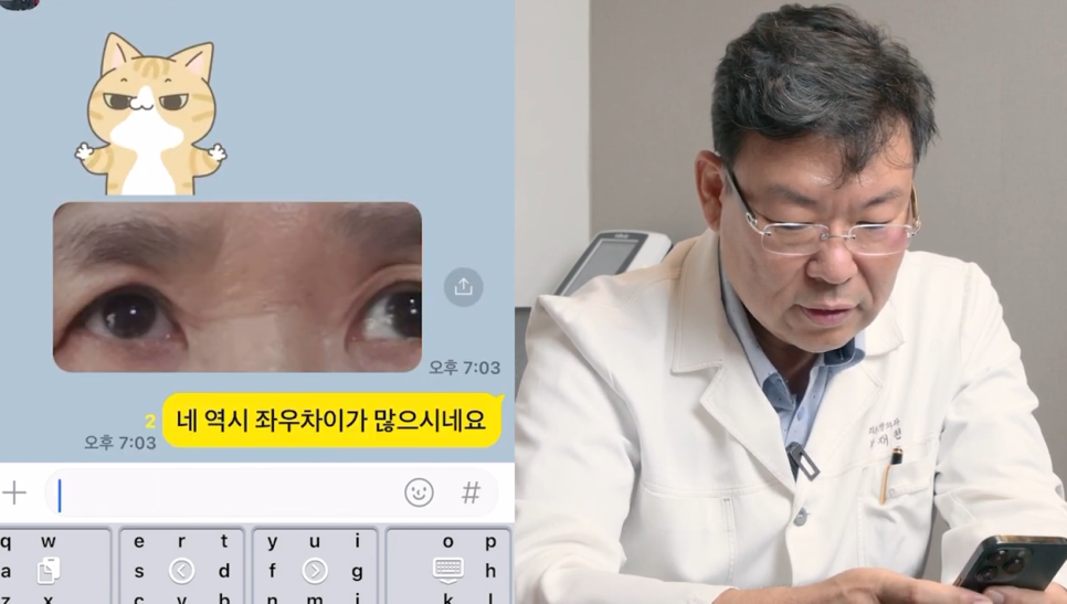 Middle-Age Concerns About Upper Blepharoplasty: Things to Check Before Surgery! image 4