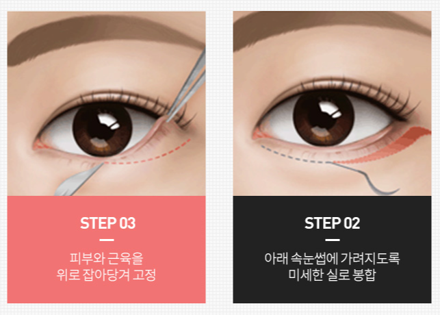 신사성형외과, 하안검 수술? 이렇게 하면 다크서클과 잔주름 사라집니다. (전문의 작성) 관련 이미지 3