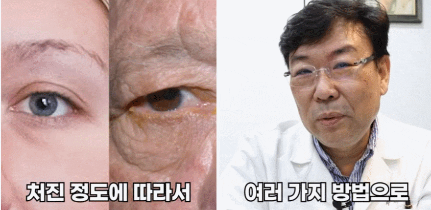 Famous Plastic Surgery Clinic in Nonhyeon-dong? A Specialist Answers Questions About Ptosis Correction (Q&A) image 3