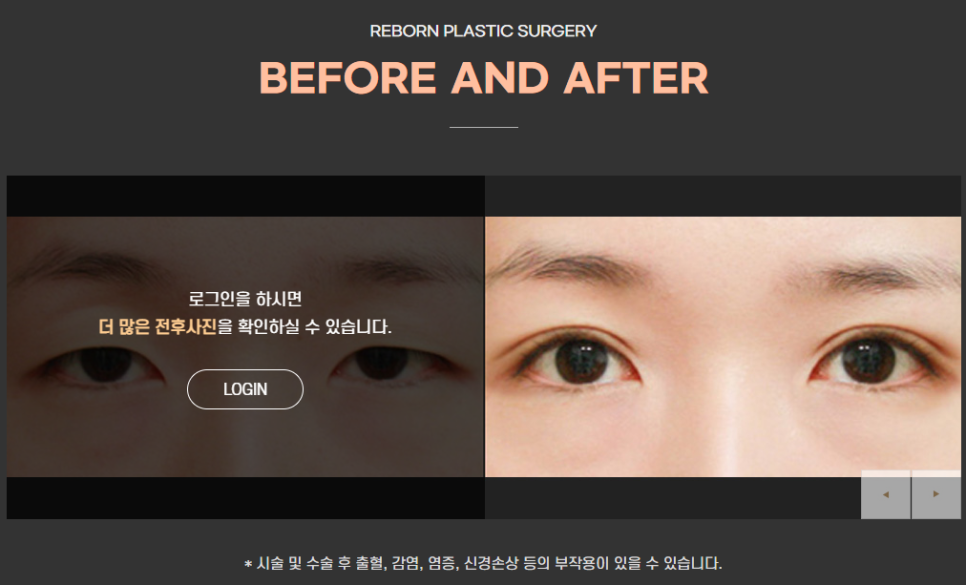 눈매교정전후 망하기 싫어 발품 팔다보면! 관련 이미지 1