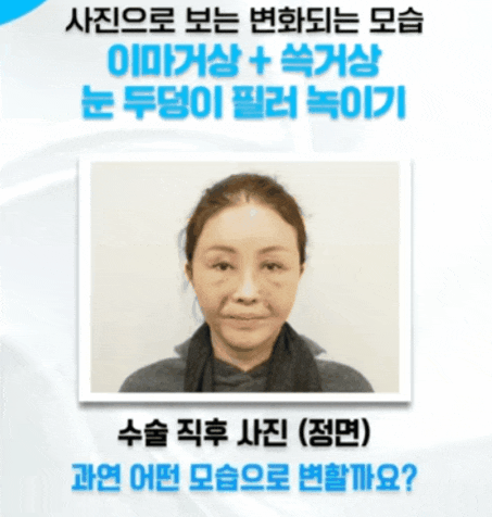 압구정역 실리프팅 성형외과 찾을 때 살펴볼 점은? 관련 이미지 1