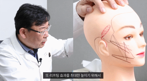 Facelift Surgery Recovery and Scars: What I’d Like to Explain image 4