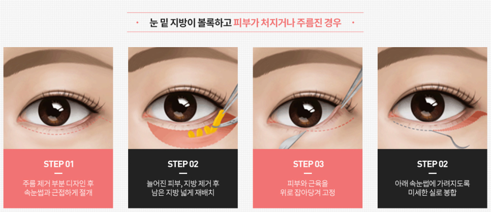 Apgujeong Middle-Aged Eye Surgery: Refined and Elegant image 9