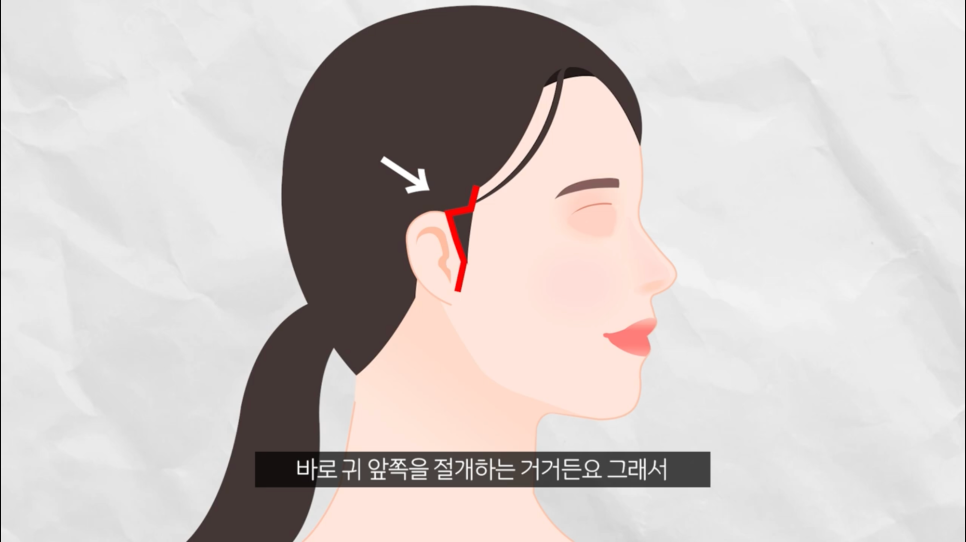 안면거상후기 미니안면거상 내돈내산 하기 전에 관련 이미지 5