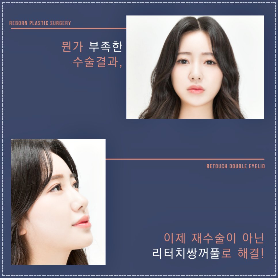 신사역쌍꺼풀 이제 재수술말아요, 리터치가 있잖아요 관련 이미지 3
