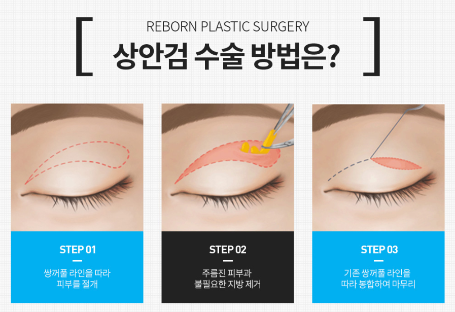 상안검하안검수술 전후 사진보다 이것 확인하세요 관련 이미지 3
