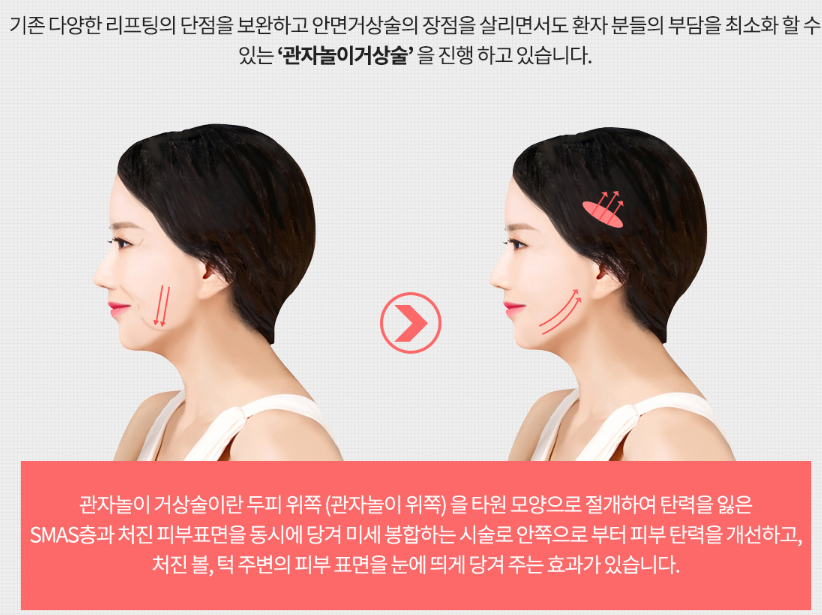 Read This Before Getting a Mini Facelift Lift image 2