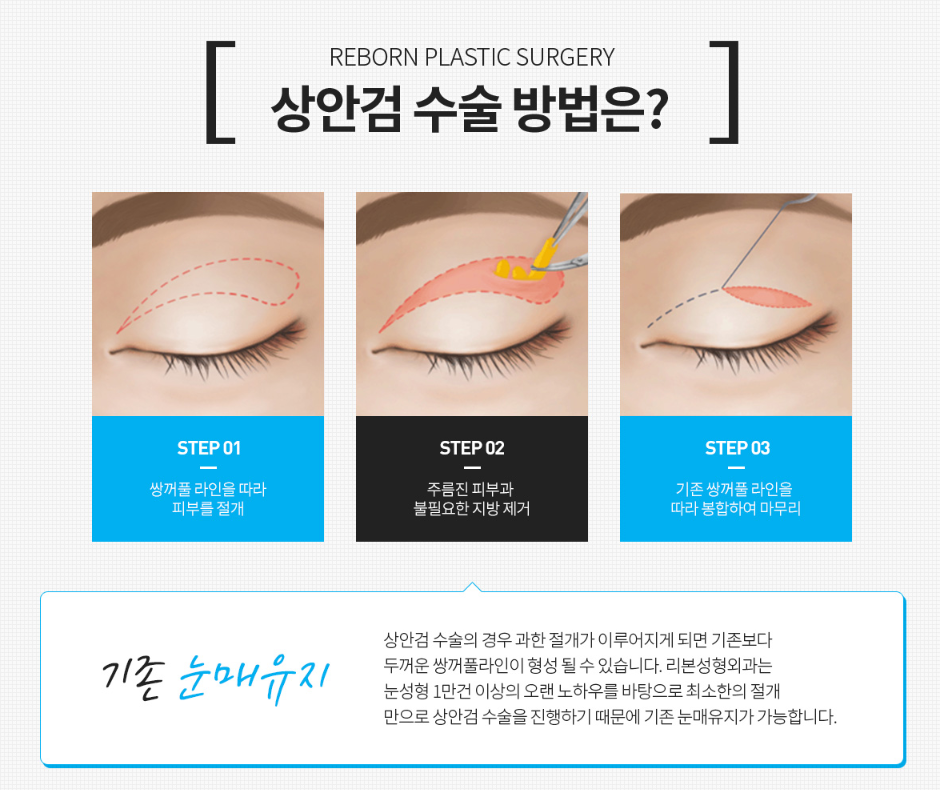 압구정눈성형 상안검 하안검 수술 내돈내산 아깝지 않게 관련 이미지 3