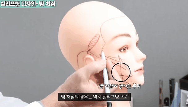 Facial Wrinkle Lifting Review, for an Effective Procedure image 5