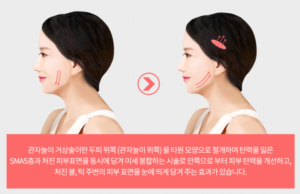 If You Decide Based Only on Before-and-After Photos for Gangnam Mini Facelift, You’ll End Up Regretting It image 3