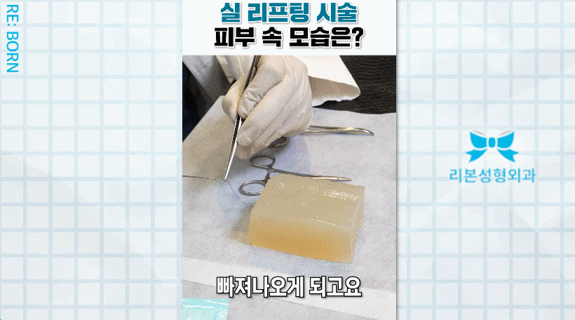 중안면부거상 수술 멍, 부기, 흉터, 회복기간 걱정된다면? 관련 이미지 4