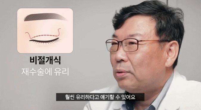 논현 절개비절개 눈매교정 최종적으로 정리해 드릴게요. 관련 이미지 2