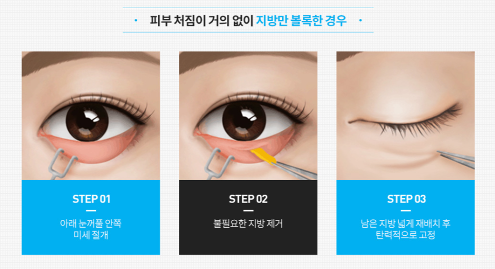 하안검수술후기 전후사진 잘 살펴보고 수술 결정하세요 관련 이미지 4