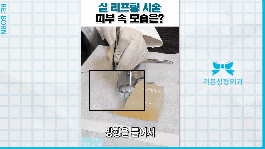 Swelling, Recovery Period, Precautions, and More After Thread Lifting image 4