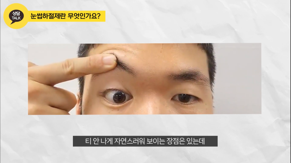 상안검 하안검 수술 후기 원장님 해결책을! 관련 이미지 3