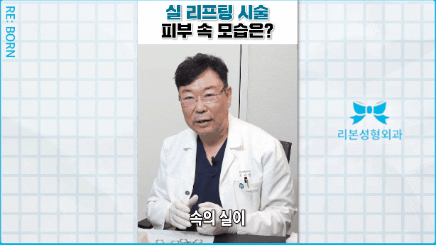중안면 거상술 붓기 회복기간 걱정된다면 관련 이미지 4