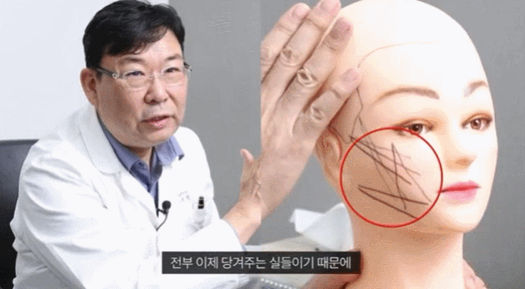 Worried That Your Face Might Look Unnatural After Cheek Fat Thread Lifting? image 3