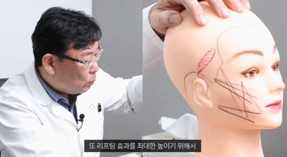 Read This Before Getting a Mini Facelift Lift image 1