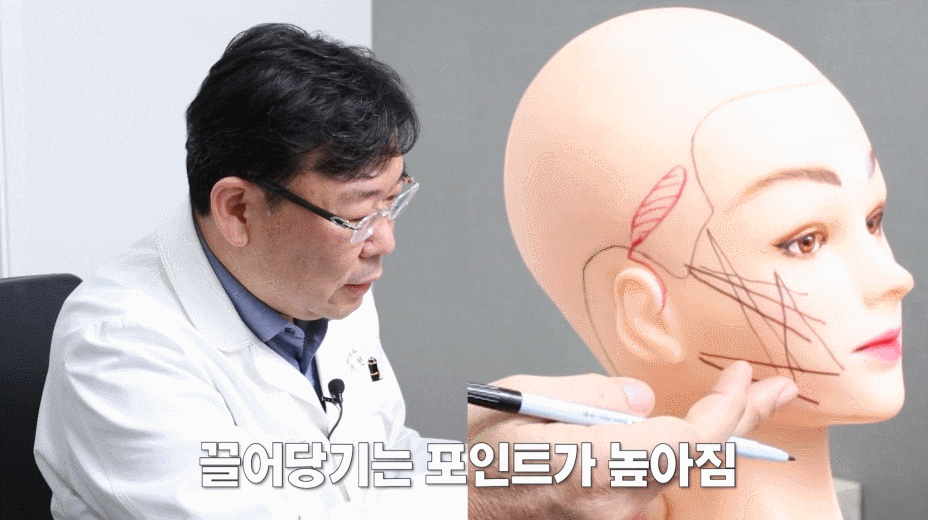 미니안면거상성형? 늘어진 눈가, 광대살 함께 개선하고 싶은 분들께 관련 이미지 2
