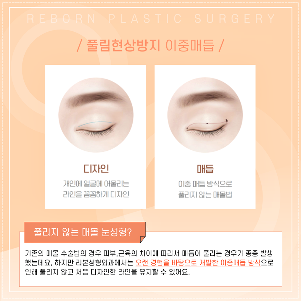 크고 화려한 나의 쌍꺼풀라인! 아웃인 매직매몰! (쌍수매몰/쌍꺼풀수술 안심진료!) 관련 이미지 3