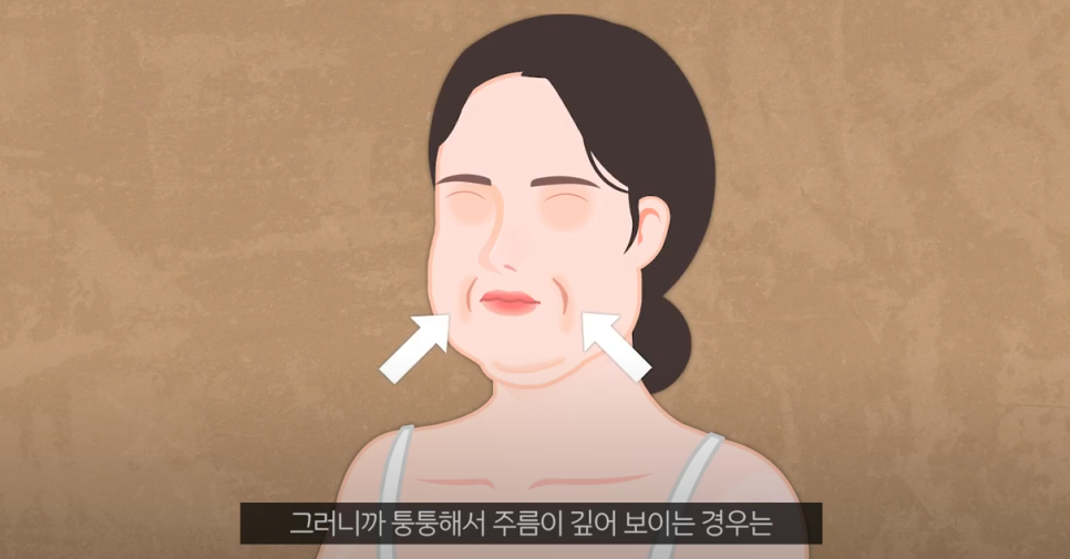 신논현성형외과 주름개선 후기 관련 이미지 4